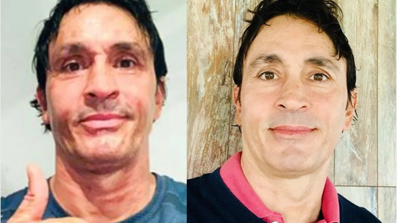 Sebastián Estevanez mostró cómo se recuperó de las quemaduras en la cara