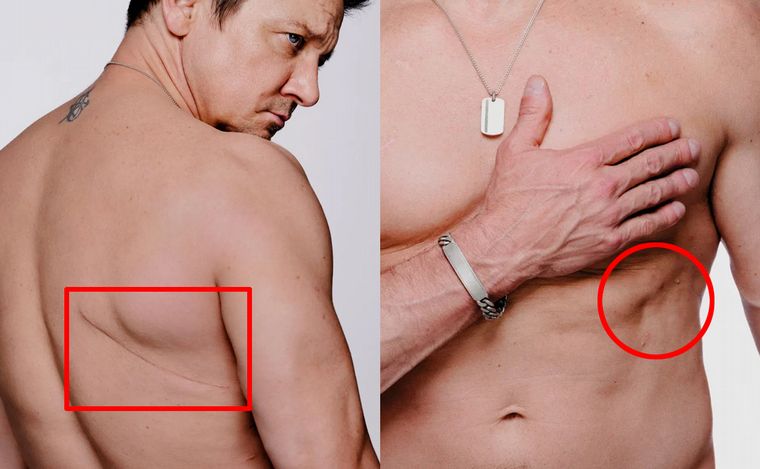 Jeremy Renner mostró las secuelas del terrible accidente con la quitanieve